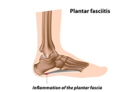 Plantar Fasciitis and Driving