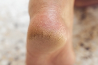 Common Reasons Why Cracked Heels Develop