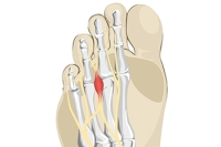 Causes and Effects of Morton’s Neuroma