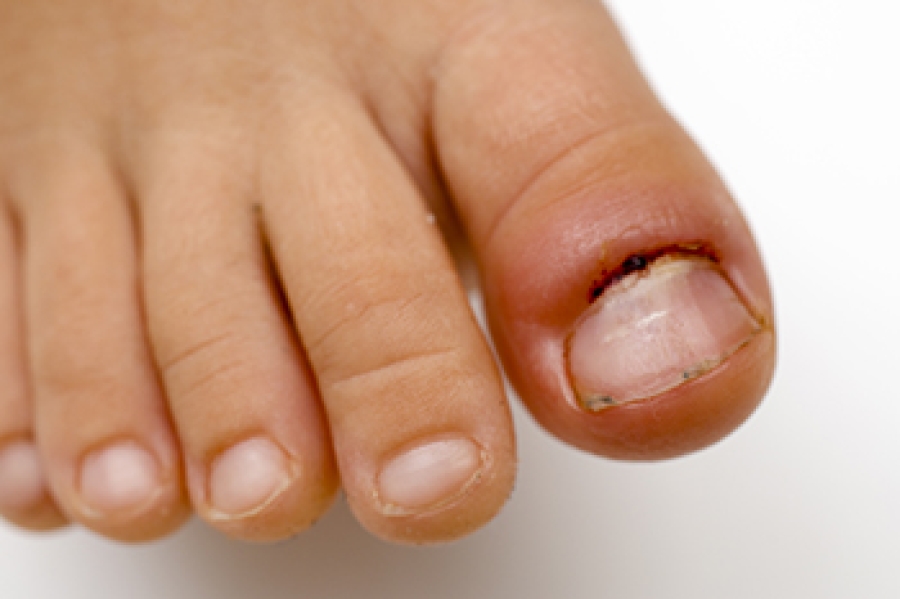 Pain in big toe nail online